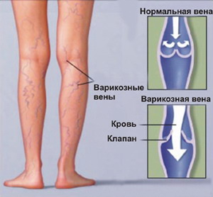 Normal and Varicose Vein